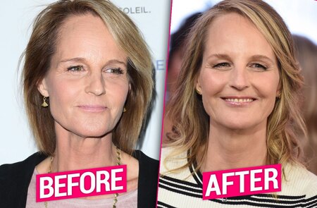 Helen Hunt before and after plastic surgery.