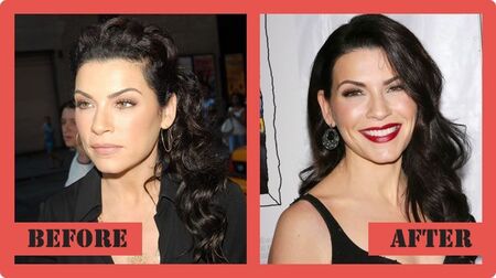 Julianna Margulies before and after plastic surgery.