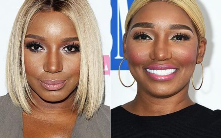 Complete Details of Every NeNe Leakes Plastic Surgery