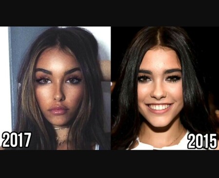 Madison Beer before and after alleged plastic surgery.