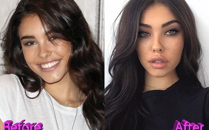 Madison Beer's Plastic Surgery - The Real Truth