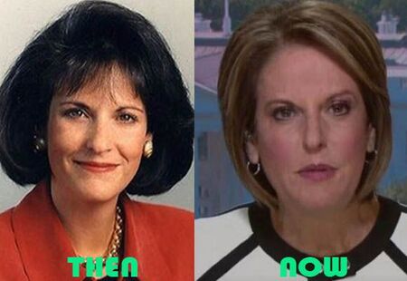 Gloria Borger before and after Facelift plastic surgery.