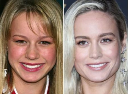 Brie Larson before and after plastic surgery.