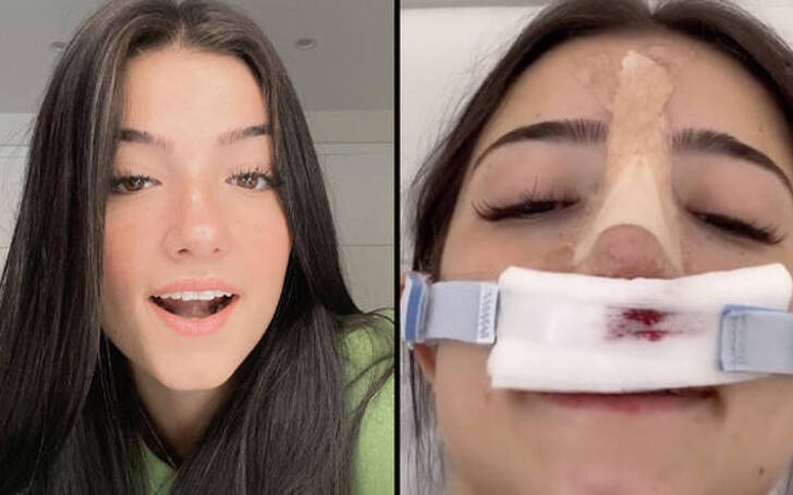 TikTok Star Charli D'Amelio's Plastic Surgery Nose Job