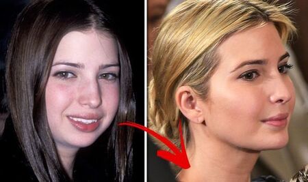 Ivanka Trump before and after plastic surgery.