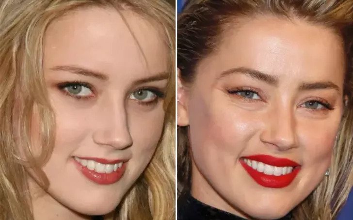 Complete Breakdown of Amber Heard's Plastic Surgery Operations.