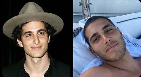 Fai Khadra before and after nose job plastic surgery.