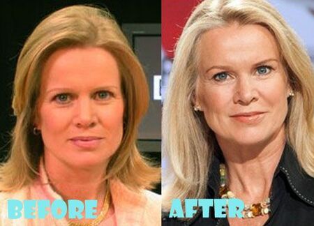 Katty Kay before and after facelift plastic surgery.