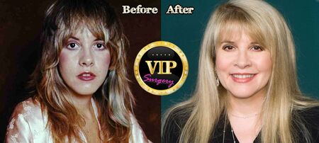 Stevie Nicks before and after plastic surgery.