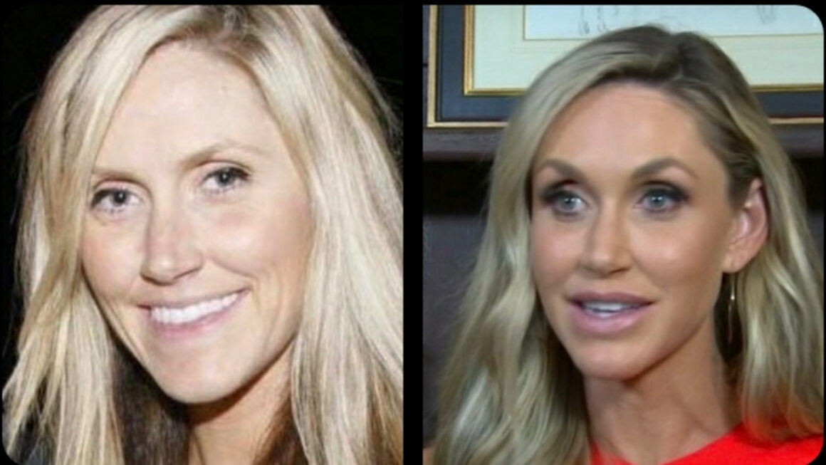 Lara Trump before and after plastic surgery.