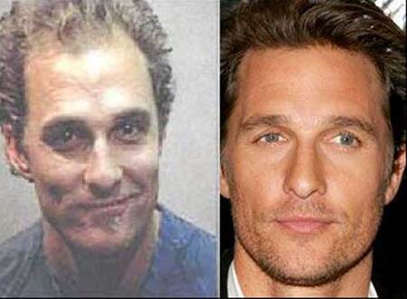 Matthew McConaughey before and after hair transplant plastic surgery.