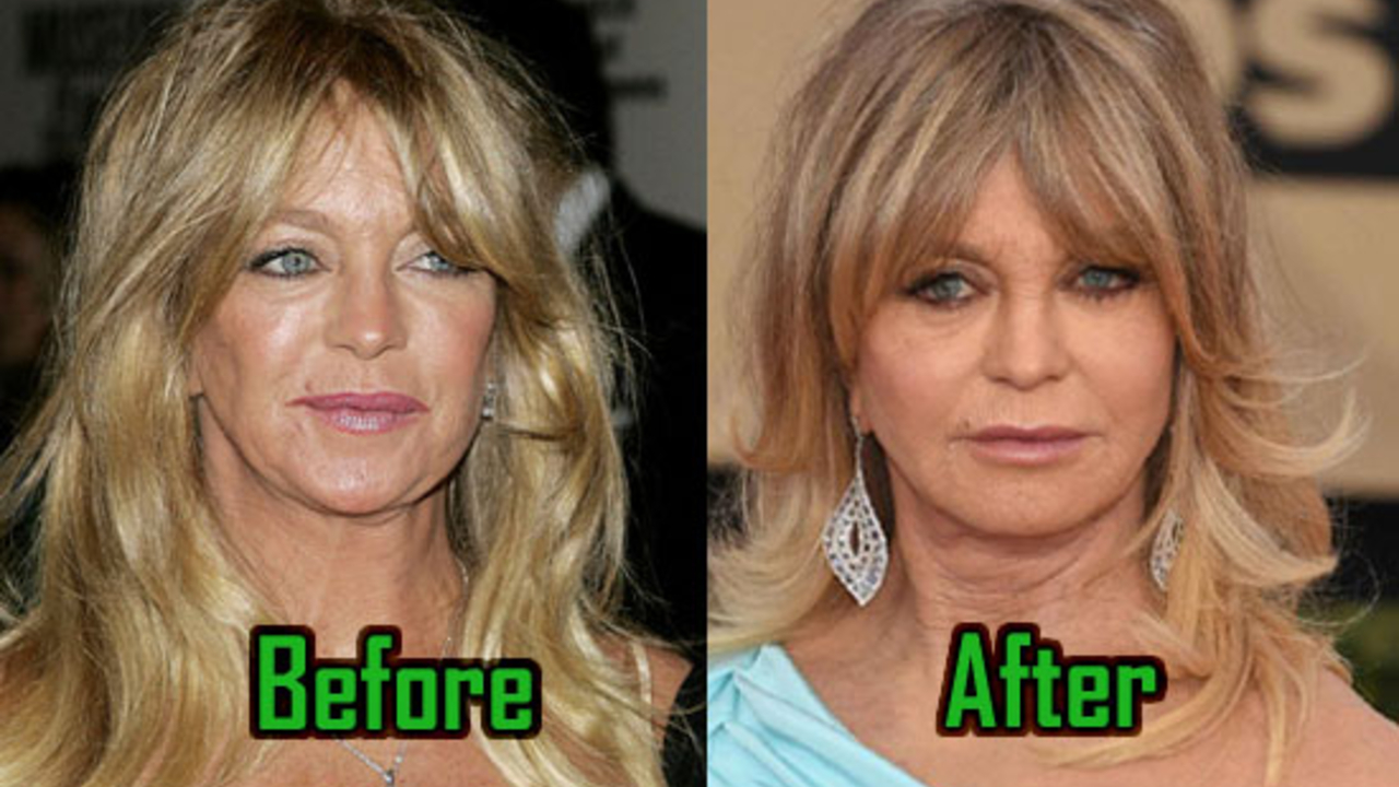 Goldie Hawn before and after plastic surgery.