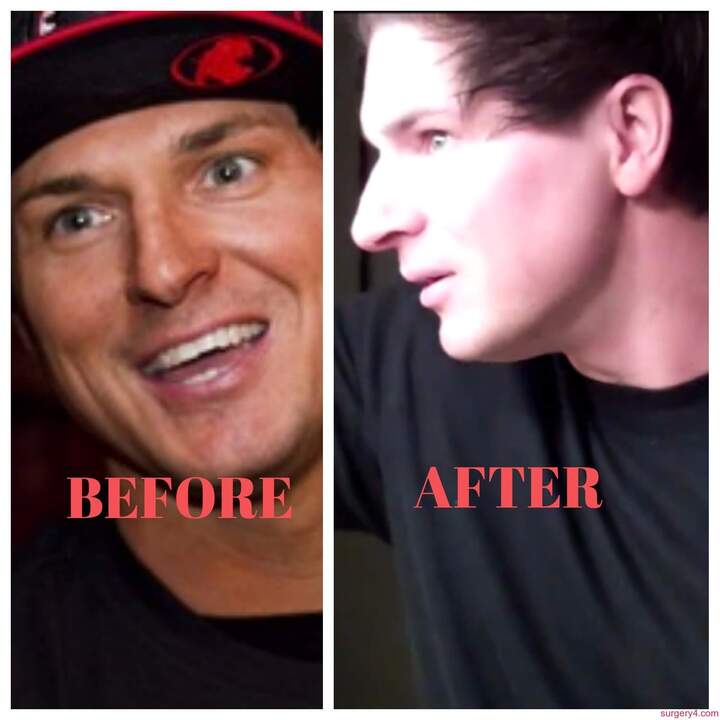 Zak Bagans before and after nose job plastic surgery.