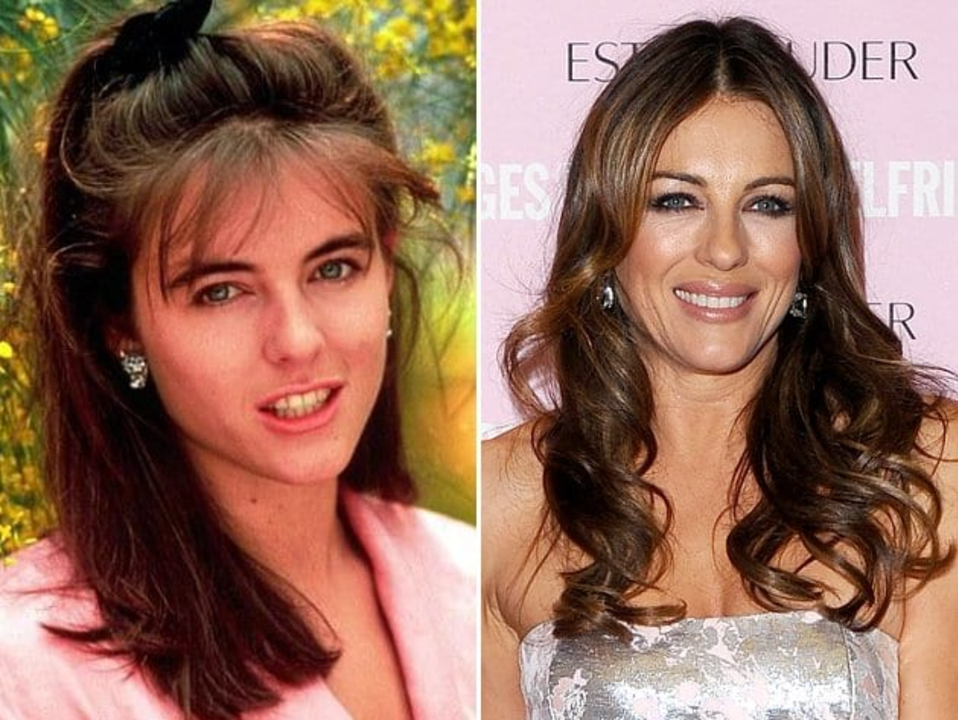 Elizabeth Hurley's plastic surgery includes lip augmentation and breast implants.