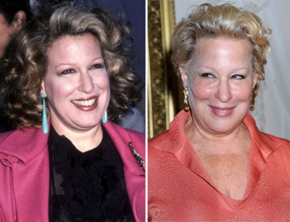 Bette Midler before and after plastic surgery.