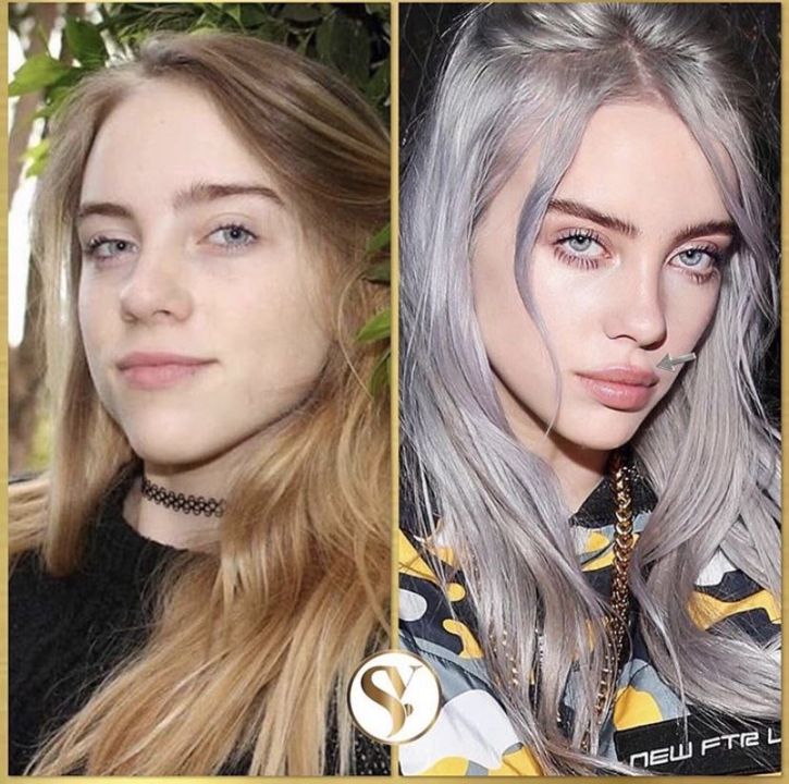 Did Billie Eilish Undergo Plastic Surgery Nose Job Body Measurements Images And Photos Finder 