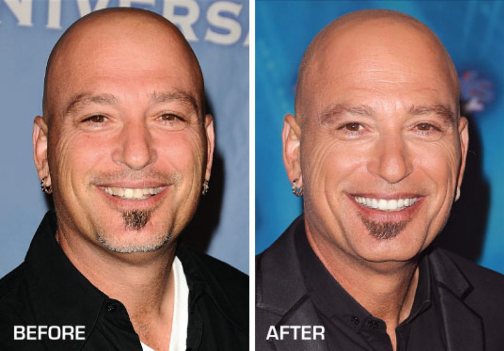 Howie Mandel before and after dental veneers plastic surgery.