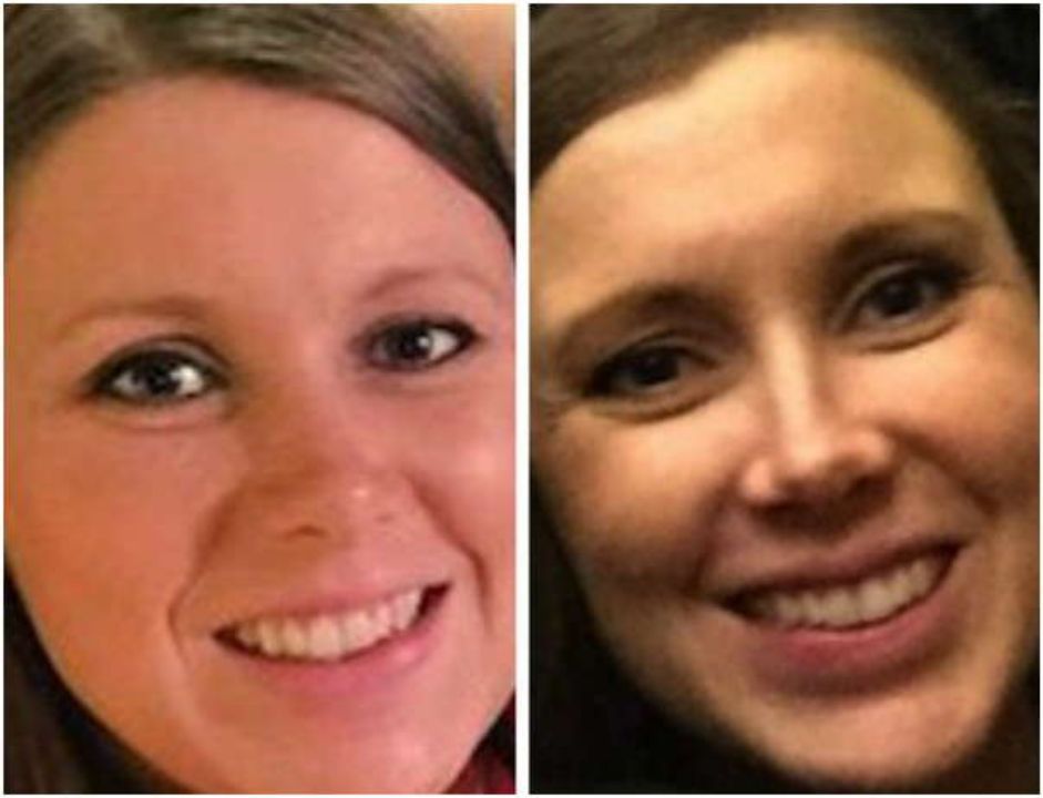 Anna Duggar before and after nose job plastic surgery.