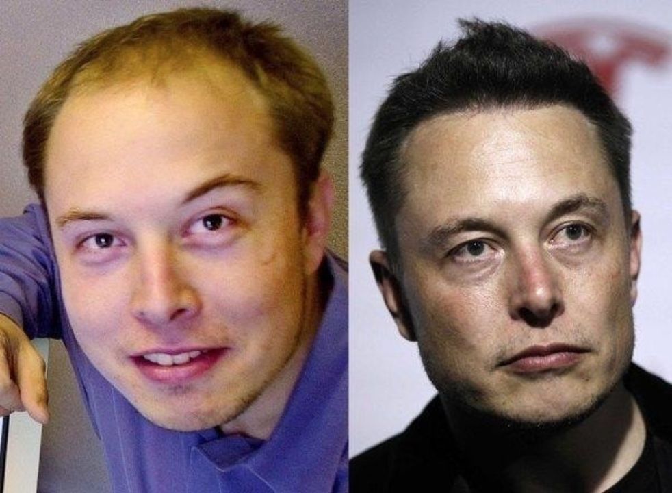 Elon Musk before and after hair transplant plastic surgery.