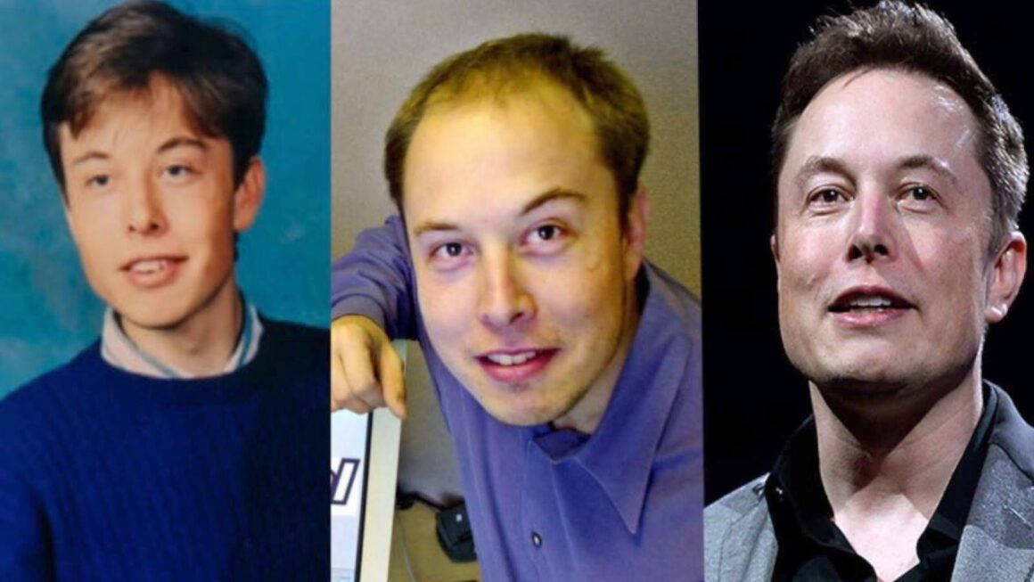 Real Truth About Elon Musk's Plastic Surgery - Facelift & Hair Transplant?