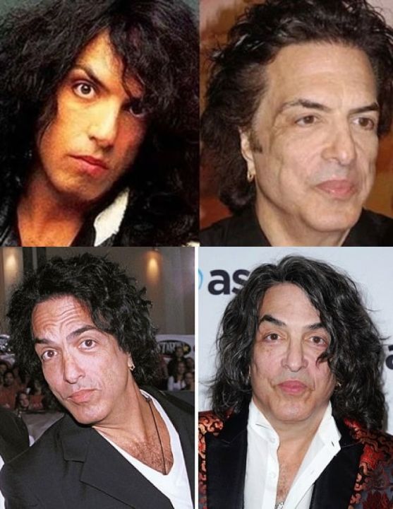 Paul Stanley before and after plastic surgery.