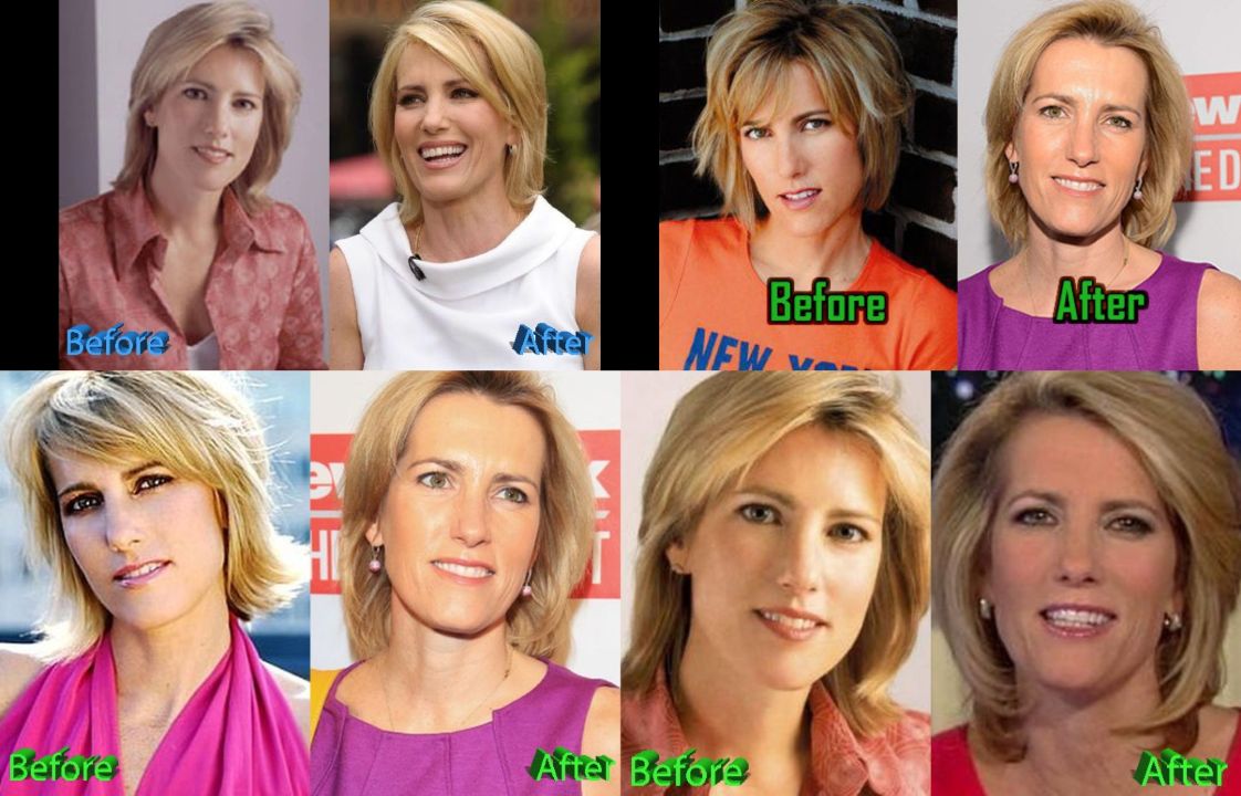 Laura Ingraham's Plastic Surgery What's Up With Her Lips?