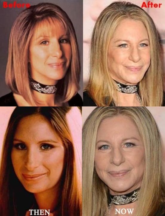 Barbra Streisand before and after alleged plastic surgery.