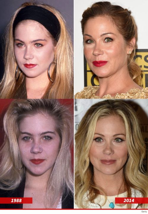 Christina Applegate before and after alleged plastic surgery.