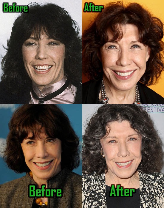 Lily Tomlin before and after alleged plastic surgery.