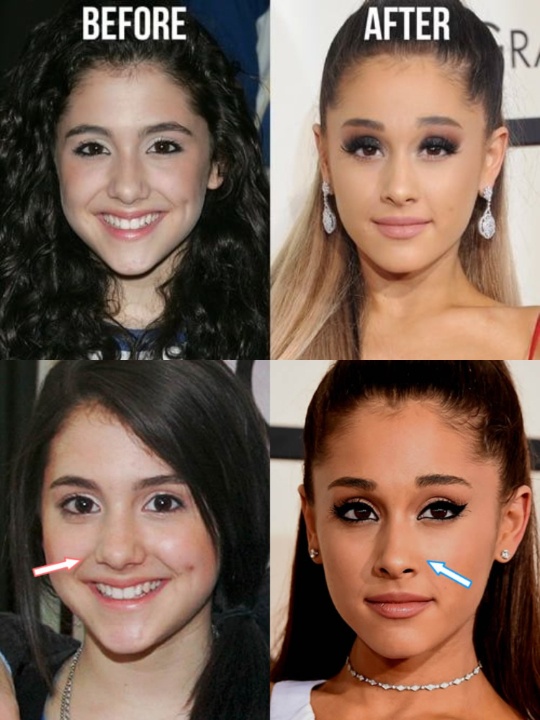 Ariana Grande before and after plastic surgery.