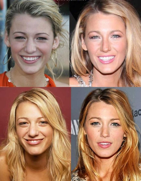 blake lively profile before nose job