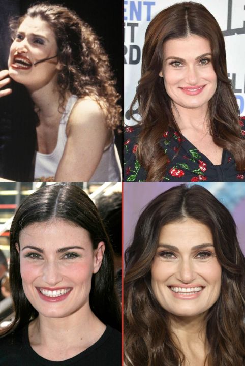 Idina Menzel before and after alleged plastic surgery.