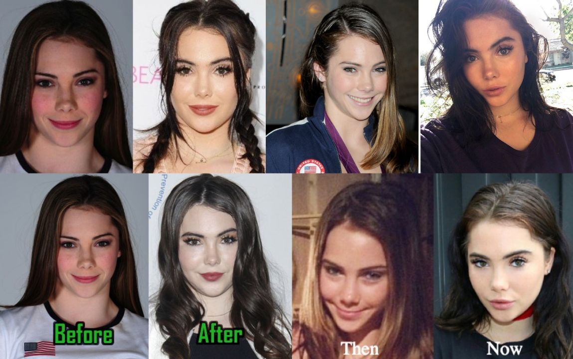 McKayla Maroney before and after plastic surgery.