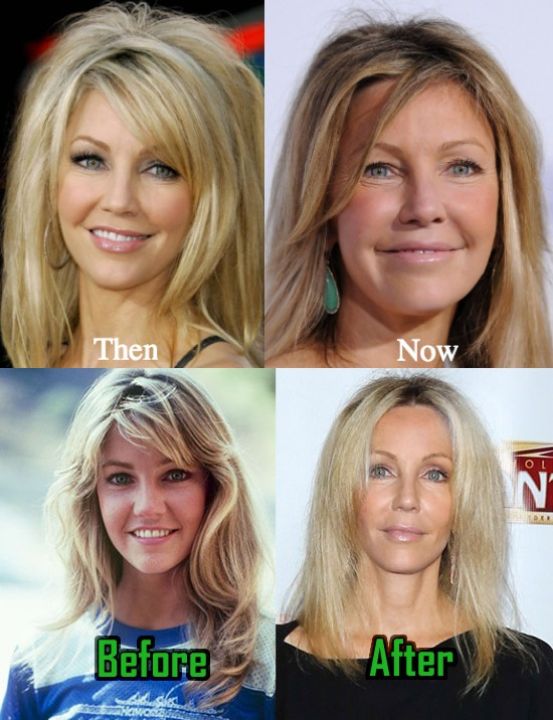Heather Locklear before and after plastic surgery.