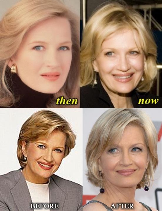 Diane Sawyer before and after plastic surgery.