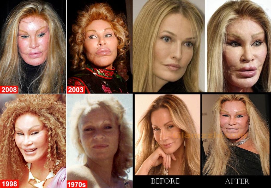 Cat face lady Jocelyn Wildenstein before and after plastic surgery through the years.