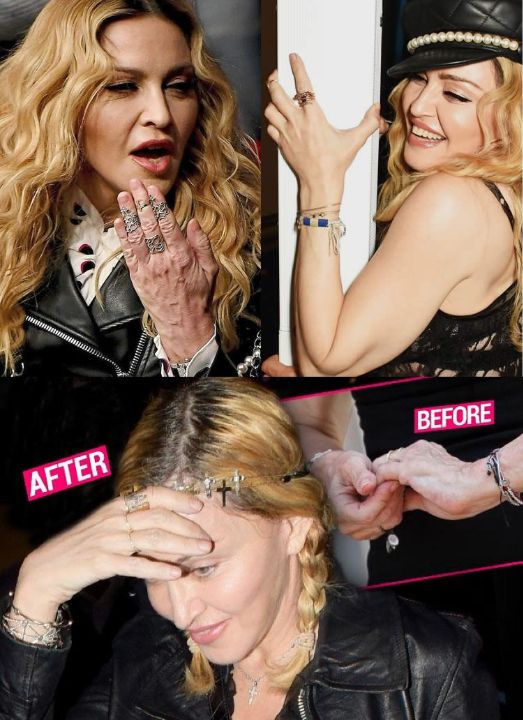 Madonna before and after her plastic surgery hands.