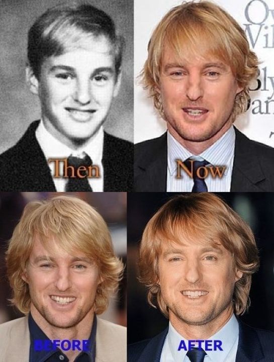 Owen Wilson before and after alleged nose job plastic surgery.