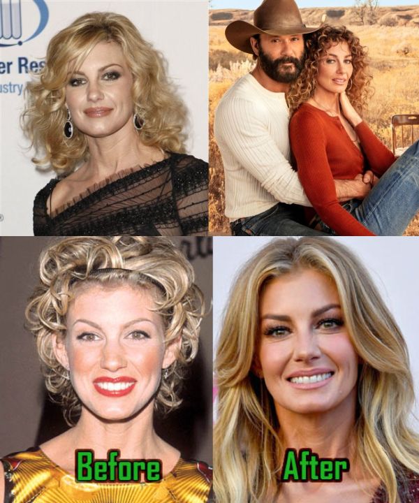 Faith Hill before and after alleged plastic surgery.