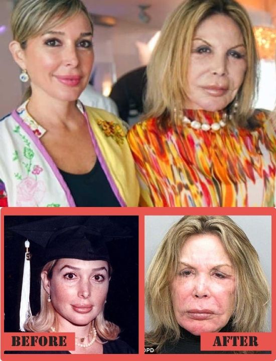 Mama Elsa Patton before and after plastic surgery.