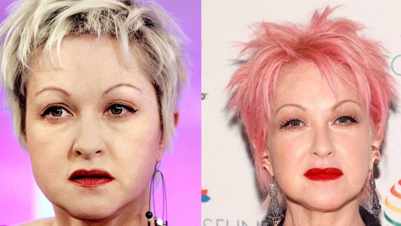 Cyndi Lauper before and after alleged plastic surgery.