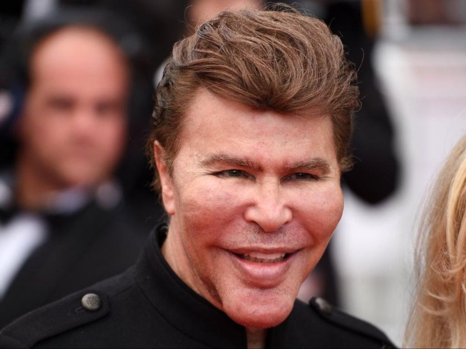 Grichka Bogdanoff's plastic surgery includes cheek implants, Botox injections, and lip fillers.