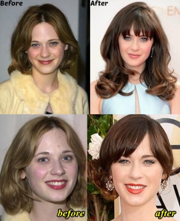 Zooey Deschanel before and after plastic surgery.