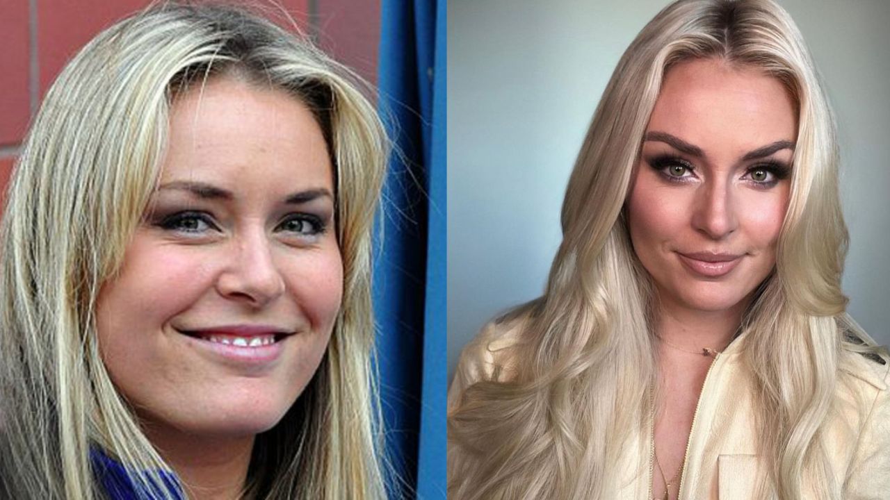 Lindsey Vonn before and after alleged plastic surgery.