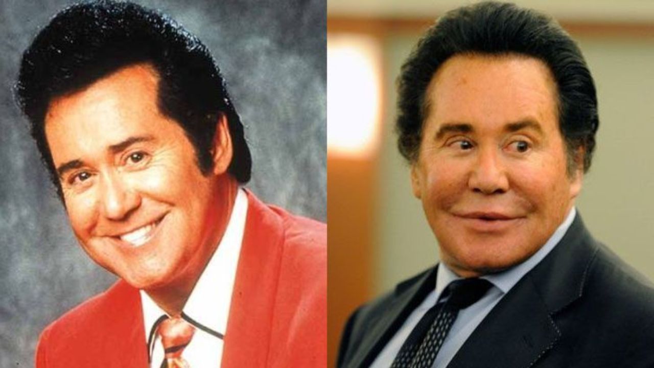 Wayne Newton's Plastic Surgery: Today The Singer Could Be The After Picture of a Botched Cosmetic Surgery