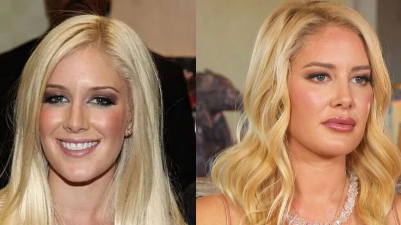 Heidi Montag Before and After Plastic Surgery: The 36-Year-Old Actress Looks Much More Younger Now in 2022!