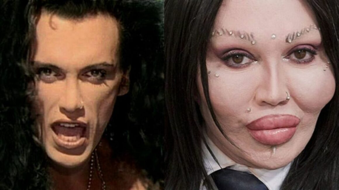 Pete Burns’ Plastic Surgery: How Was the Singer When He Was Young? Was Multiple Cosmetic Treatments His Cause of Death?