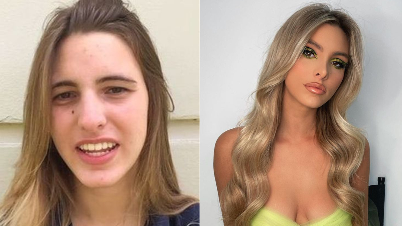 Lele Pons' Plastic Surgery: Before and After Pictures Examined!