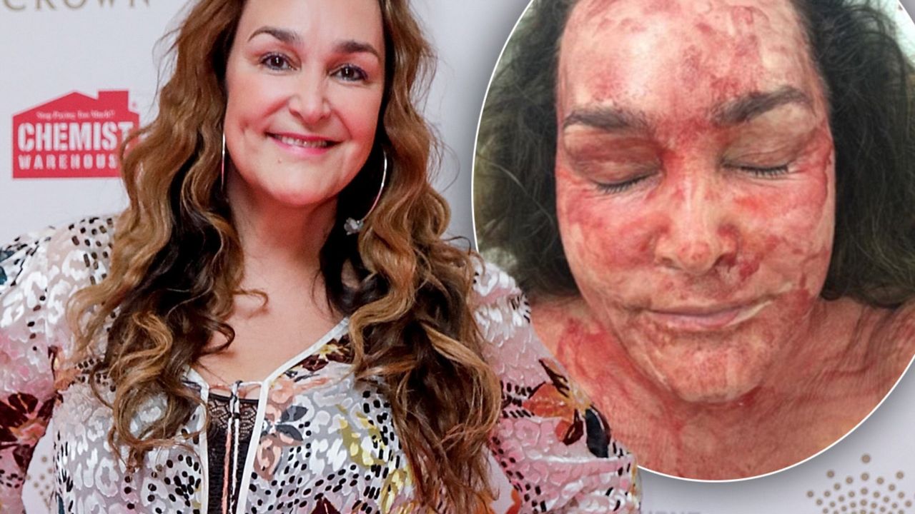 Kate Langbroek received a horrific cosmetic treatment (Vamore Facial) to look younger than her age. weightandskin.com
