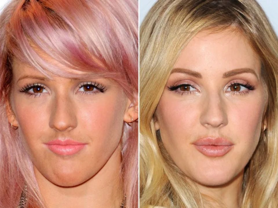 Ellie Goulding before and after plastic surgery. weightandskin.com